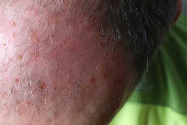 Seborrheic Keratoses FAQS