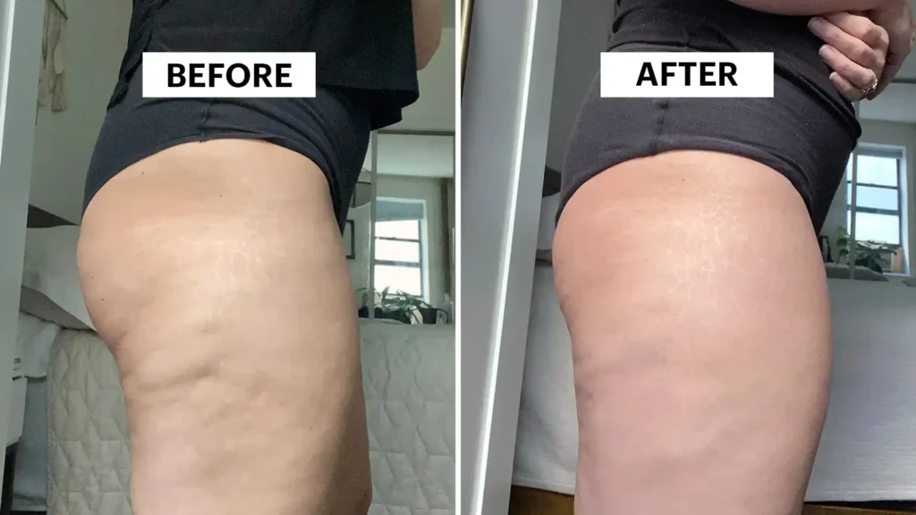 Sculpting Your Bum: Can Toning Exercises Really Reduce Cellulite? 1 Do Toning Exercise Worthing Really Tackle Cellulite?