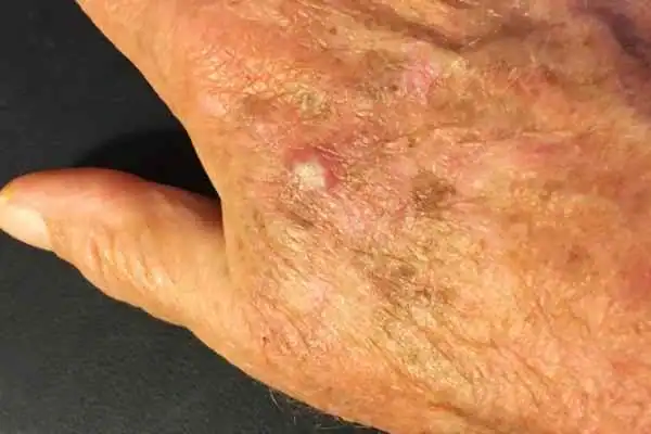 Cryopen For Actinic Keratoses 1 Image of Actinic keratoses Worthing on a person hand