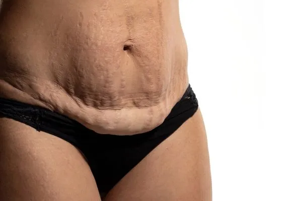 The Science of Skin Tightening 1 The science behind skin tightening Worthing picture of a woman's sagging skin on the stomach